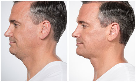 kybella double chin treatment before and after